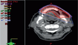 Peripheral T-cell lymphoma of the lip: a rare case unveiling key insights into diagnosis and management