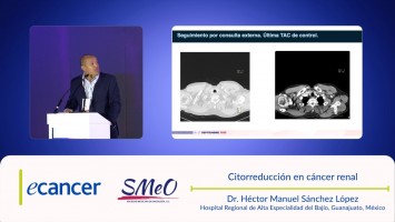 Citorreducción en cáncer renal ( Dr. Héctor Manuel Sánchez López - Hospital Regional de Alta Especialidad del Bajío, Guanajuato, México )