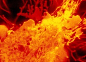 Un nuevo ensayo sobre el cáncer de próstata busca reducir la toxicidad sin sacrificar la eficacia