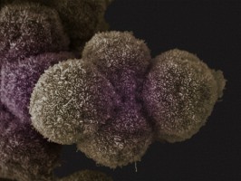 Let’s get on pancreatic cancer’s nerves