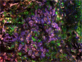 Machine-learned biomarker identifies those at high risk for liver cancer