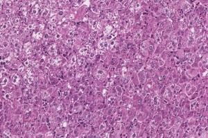 A new mouse model of virus-driven liver cancer may open the door to better diagnosis and treatments