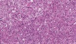 A new mouse model of virus-driven liver cancer may open the door to better diagnosis and treatments