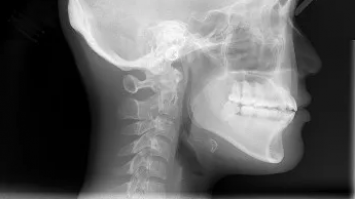 AACR 2026: El nivolumab intralesional podría resultar eficaz contra las lesiones bucales precancerosas