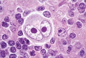 Understanding the origins of Hodgkin lymphoma cells could lead to better diagnostics