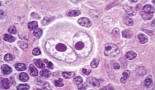 Understanding the origins of Hodgkin lymphoma cells could lead to better diagnostics