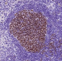 Discovery of a novel vulnerability in aggressive lymphoma could change future therapy