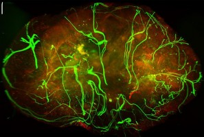 Nerves in skin can slow melanoma growth
