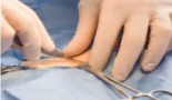 Preservación del haz neurovascular durante la prostatectomía radical robótica: consejos y trucos