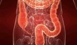 Una única sigmoidoscopia de cribado se asocia a un menor riesgo de cáncer colorrectal dos décadas después
