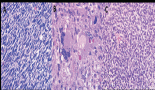 2133-primary-intracranial-sarcomas-in-peruvian-children-a-high-incidence-clinicopathological-series-from-a-national-reference-center