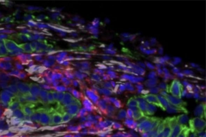 Vitamin D analog shuts down pancreatic cancer’s shield in clinical trial