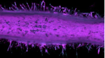 Un descubrimiento sobre el cáncer de páncreas avanza hacia un ensayo clínico pionero en su género