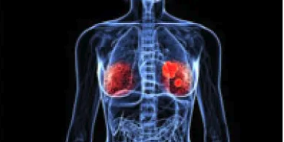 El tejido adiposo podría explicar la diseminación del cáncer de mama triple negativo y apuntar hacia posibles tratamientos
