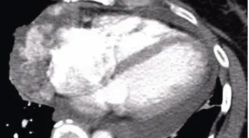 Los retos socioeconómicos influyen en la experiencia de los pacientes con respecto a las pruebas de detección del cáncer de pulmón