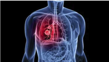 El nuevo enfoque de los investigadores potencia la respuesta inmunitaria contra el cáncer de pulmón