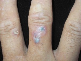 Rare but real: Why a common skin cancer can hide on a finger