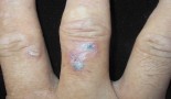 Rare but real: Why a common skin cancer can hide on a finger