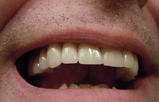 New brush test detects oral cancer in one hour