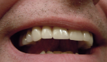 New brush test detects oral cancer in one hour