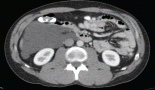2168-key-principles-for-the-initial-management-of-primary-retroperitoneal-tumours-in-adults