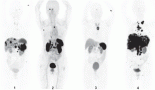 2171-use-of-18f-alf-nota-octreotide-pet-ct-as-a-diagnostic-test-for-the-detection-of-neuroendocrine-tumours-a-histopathology-referenced-diagnostic-accuracy-study