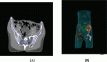 2173-comparative-dosimetric-and-clinical-evaluation-of-bone-marrow-sparing-imrt-bm-imrt-versus-without-bone-marrow-sparing-imrt-wbm-imrt-in-pelvic-radiotherapy-for-cervical-cancer