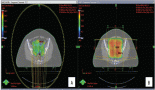 2208-reducing-acute-haematological-toxicity-in-cervical-cancer-a-comparative-study-of-bone-marrow-sparing-vmat-and-3dcrt