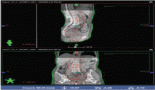 2209-evaluation-of-setup-errors-and-ctv-ptv-margin-assessment-in-pelvic-cancer-patients-undergoing-image-guided-radiotherapy