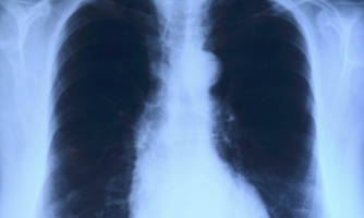 WCLC 2026: Analysis shows ivonescimab significantly improves overall survival versus pembrolizumab in PD-L1-positive advanced NSCLC
