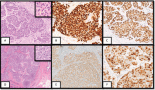 2233-primary-neuroendocrine-neoplasms-of-the-breast-a-clinicopathological-appraisal-from-a-tertiary-cancer-centre-of-north-india
