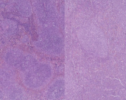 Six-gene scoring system could help predict leukaemia survival